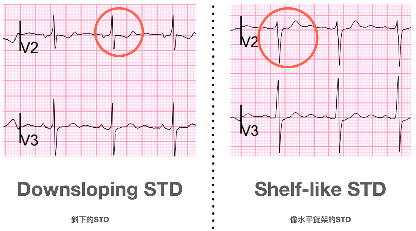 Downsloping STD vs. Shelf-like STD