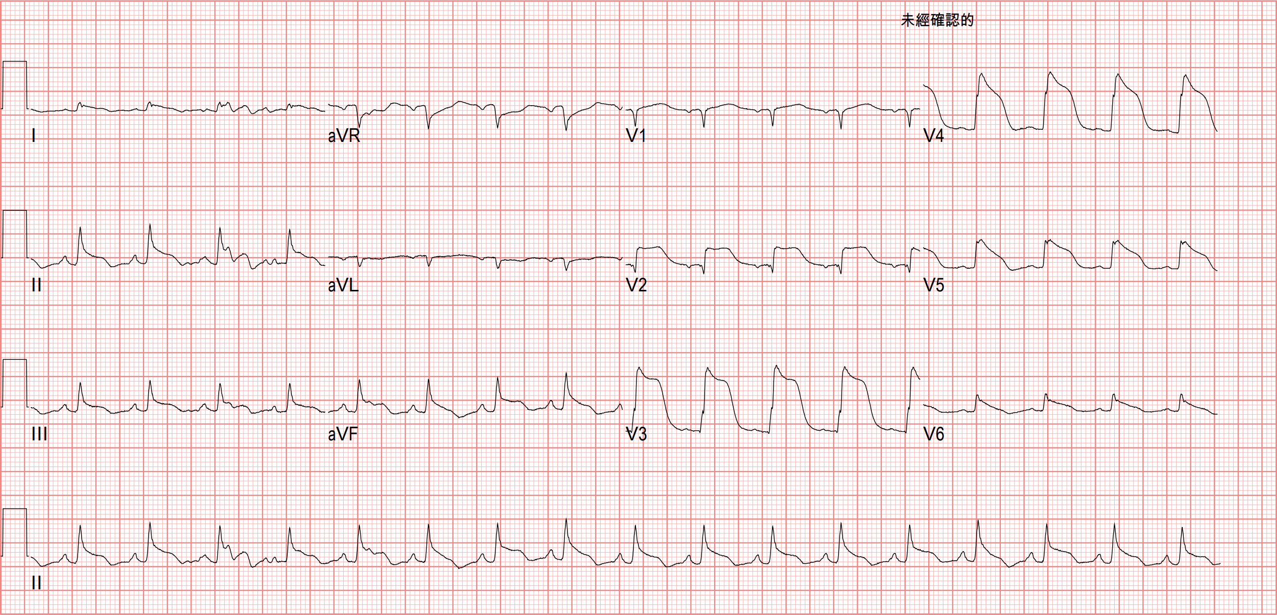 Day 3 ECG