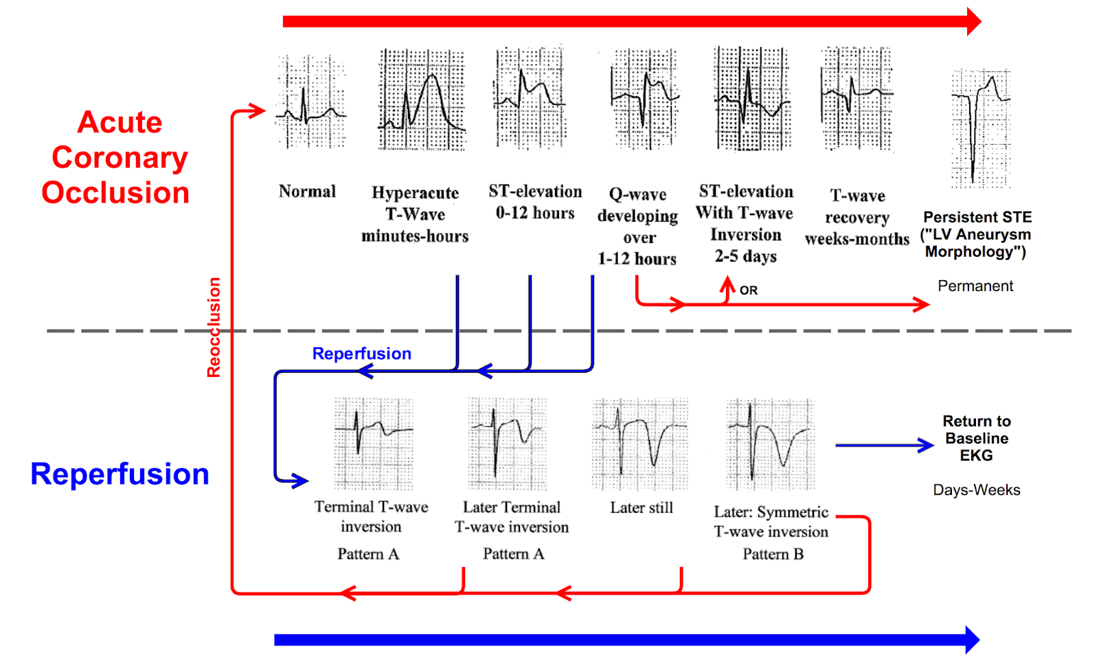 The OMI Progression/Reperfusion on ECG