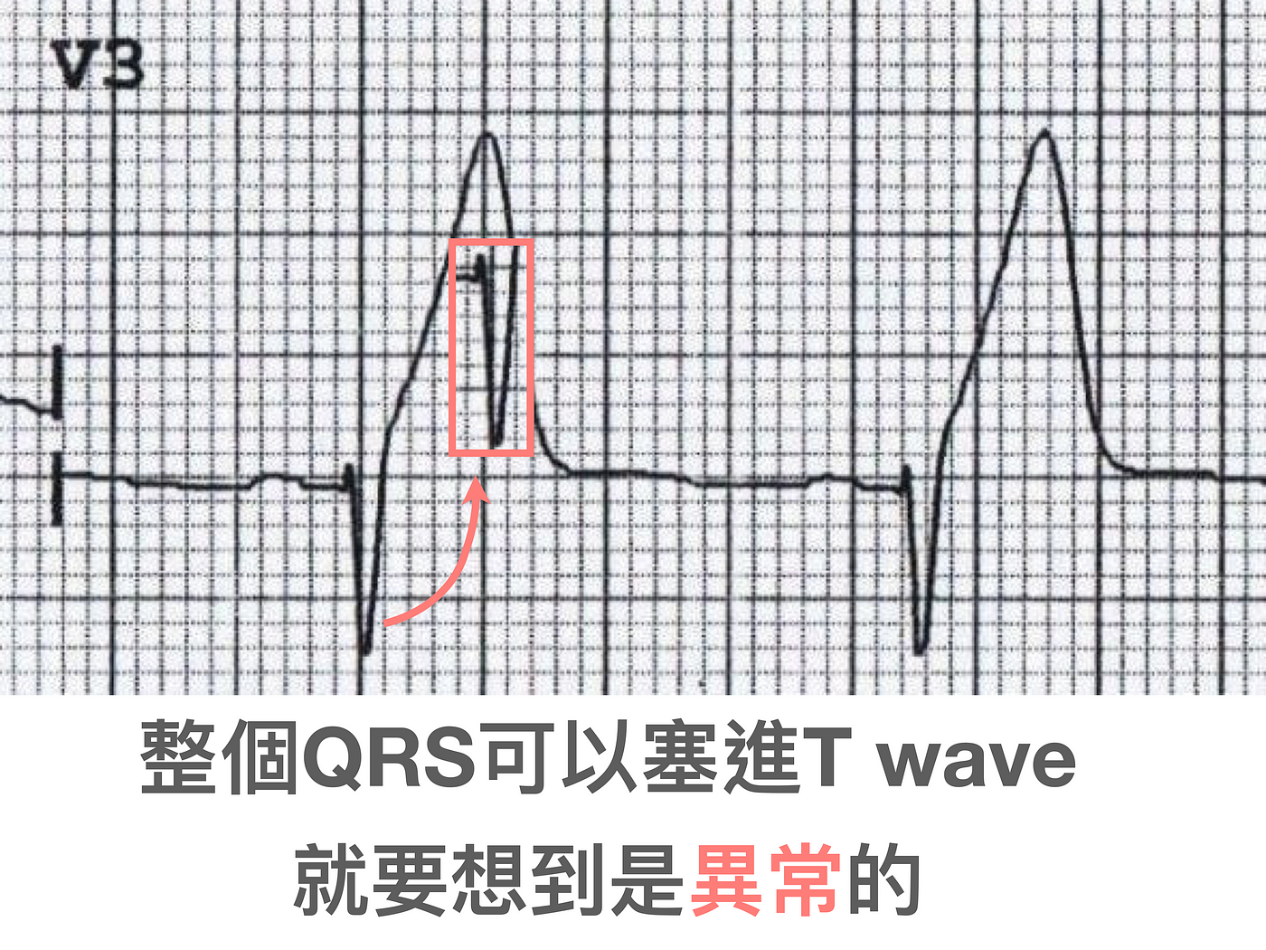 Abnormal T wave