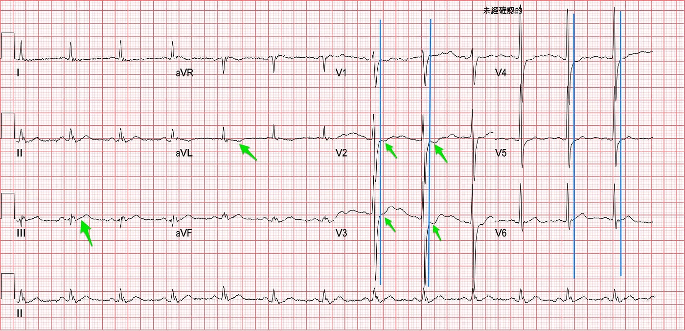 Initial ECG