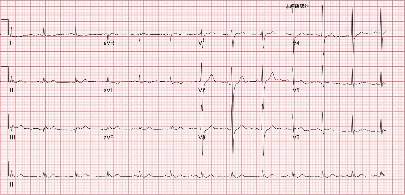 F/U ECG