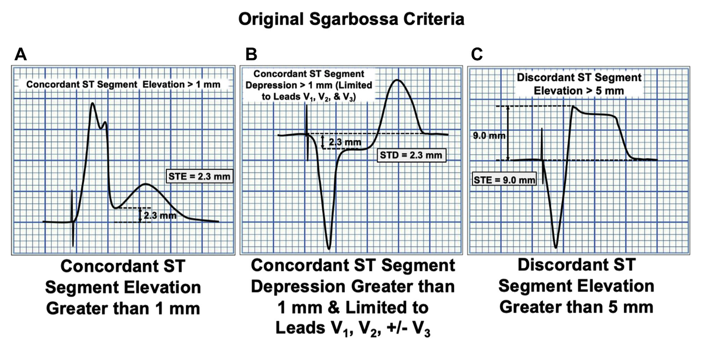 Original Sgarbossa criteria