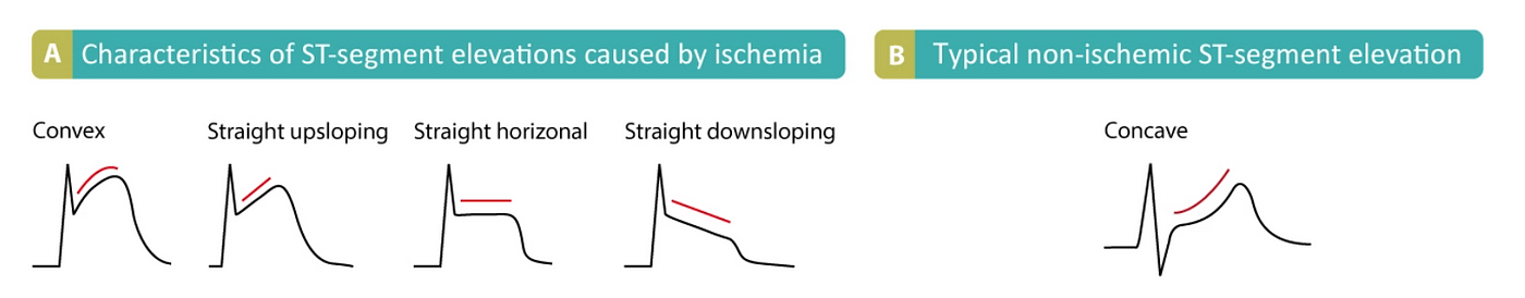 ischemic pattern STE