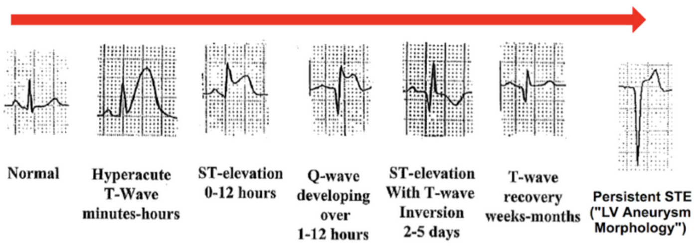 The OMI Progression on ECG