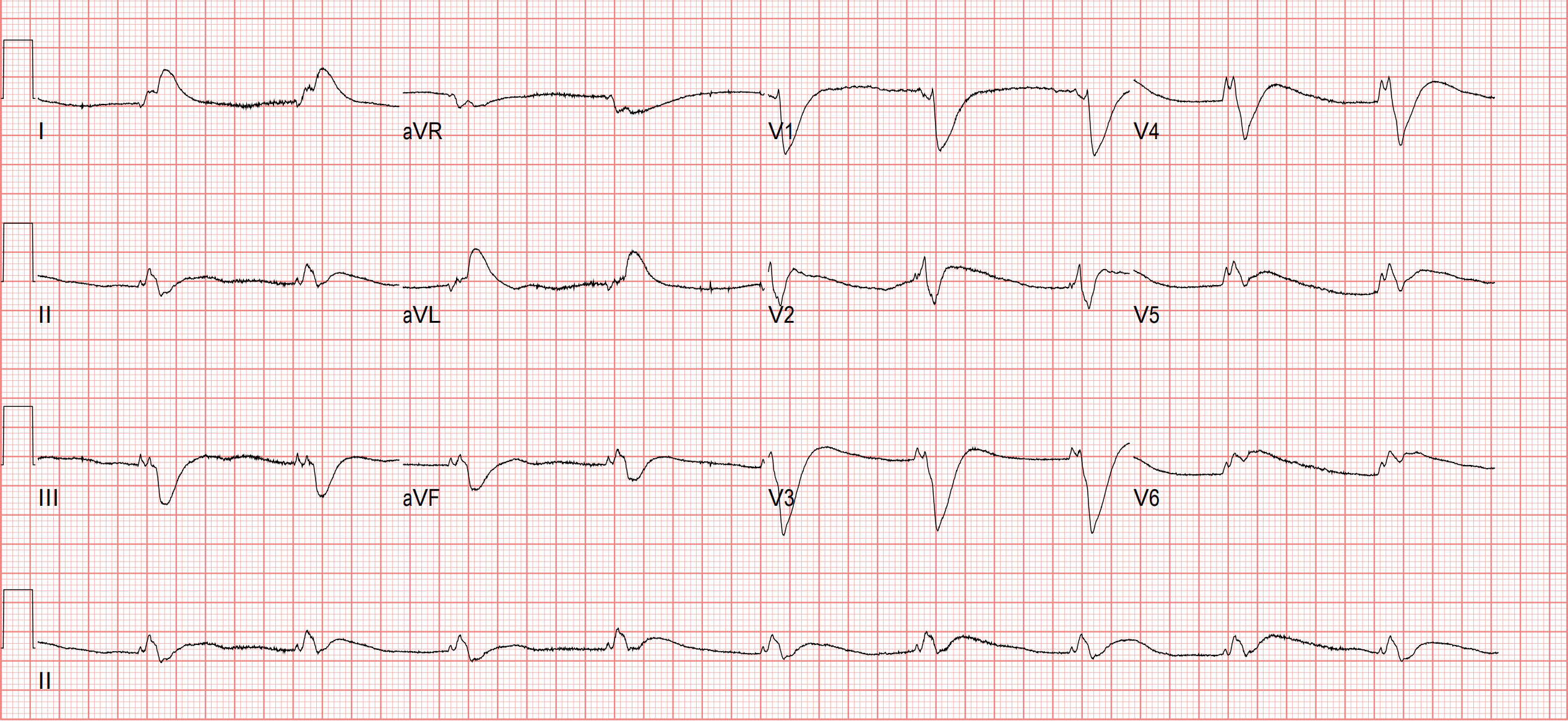 ROSC後的第一張ECG