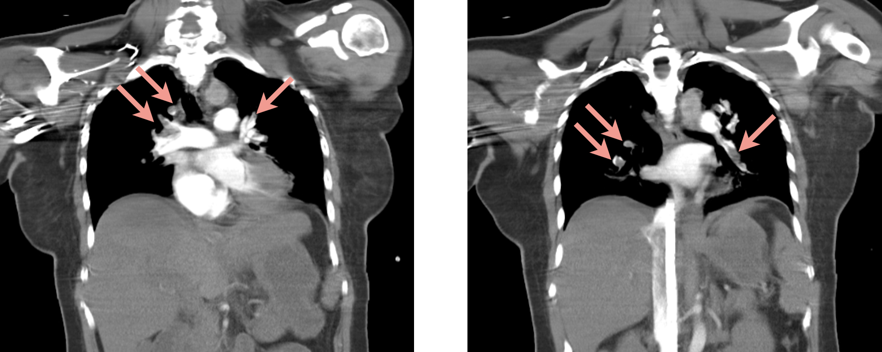 Chest CTA