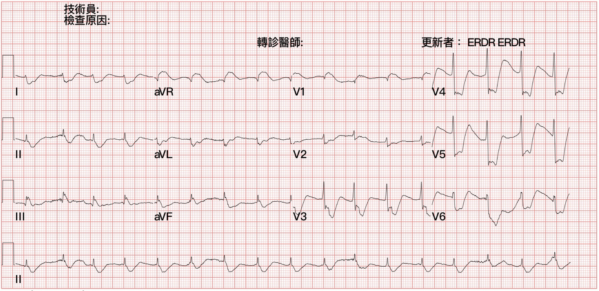 ROSC後的第一張ECG