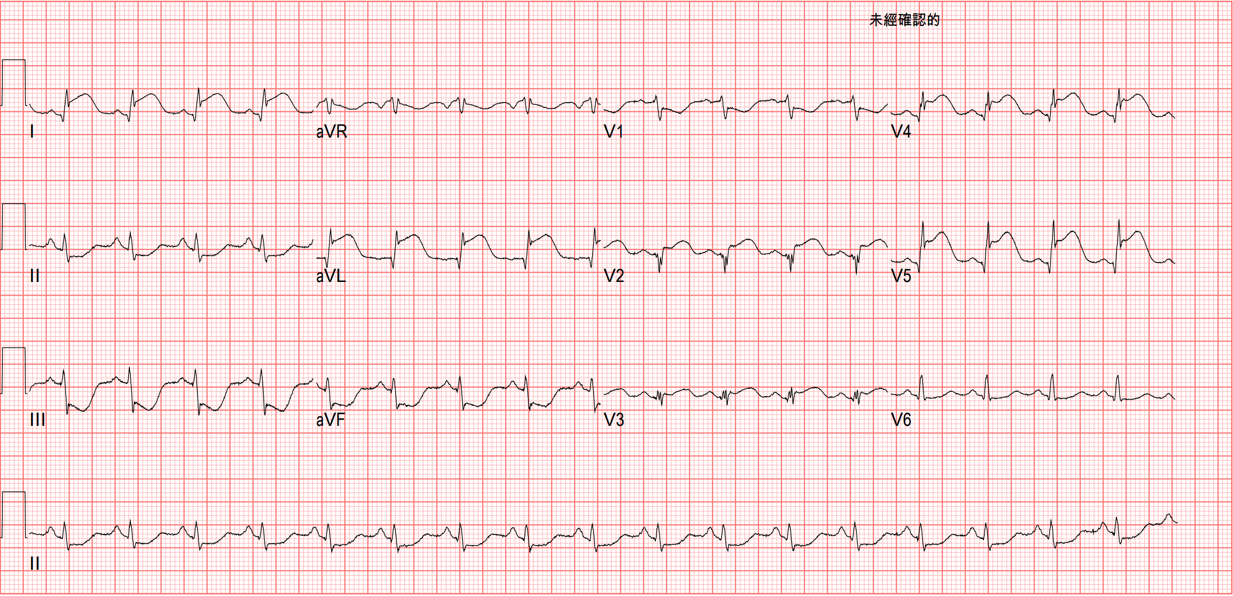 Post CPR的ECG