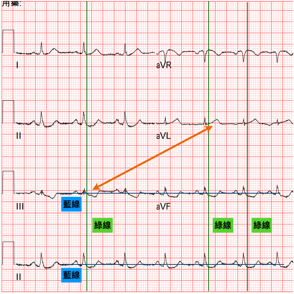 病患Limb leads ECG Change