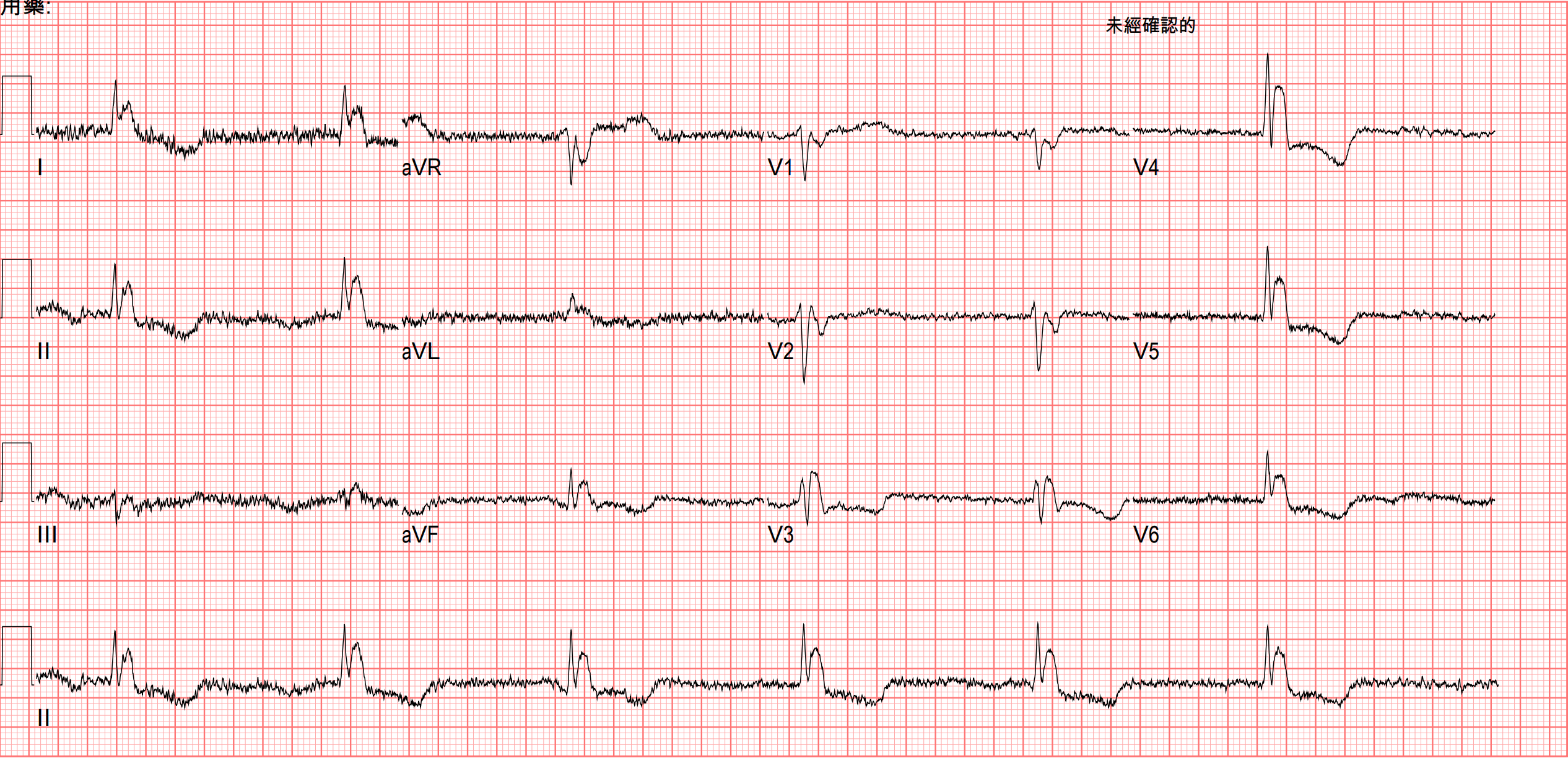 到院時ECG