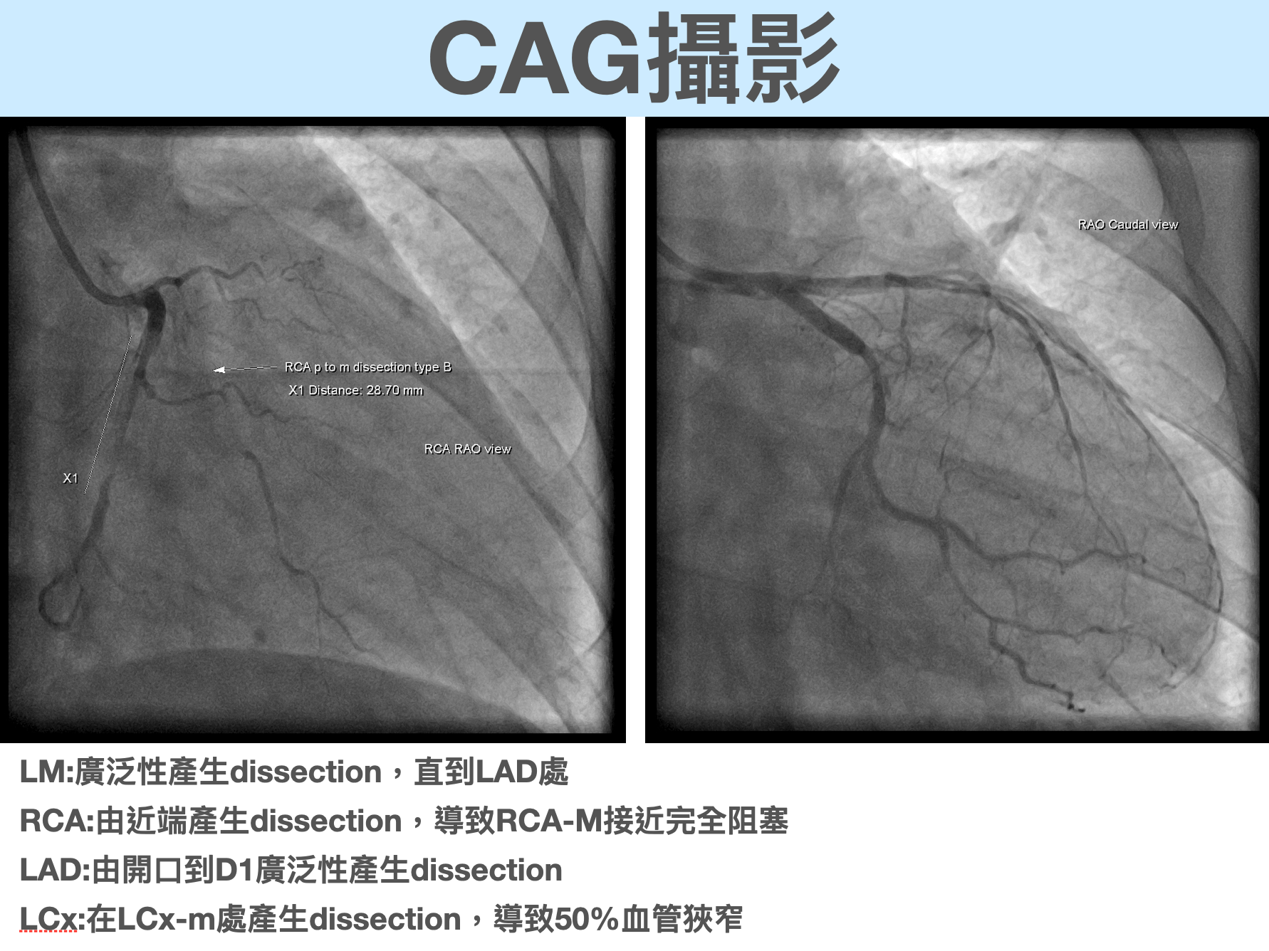 CAG報告