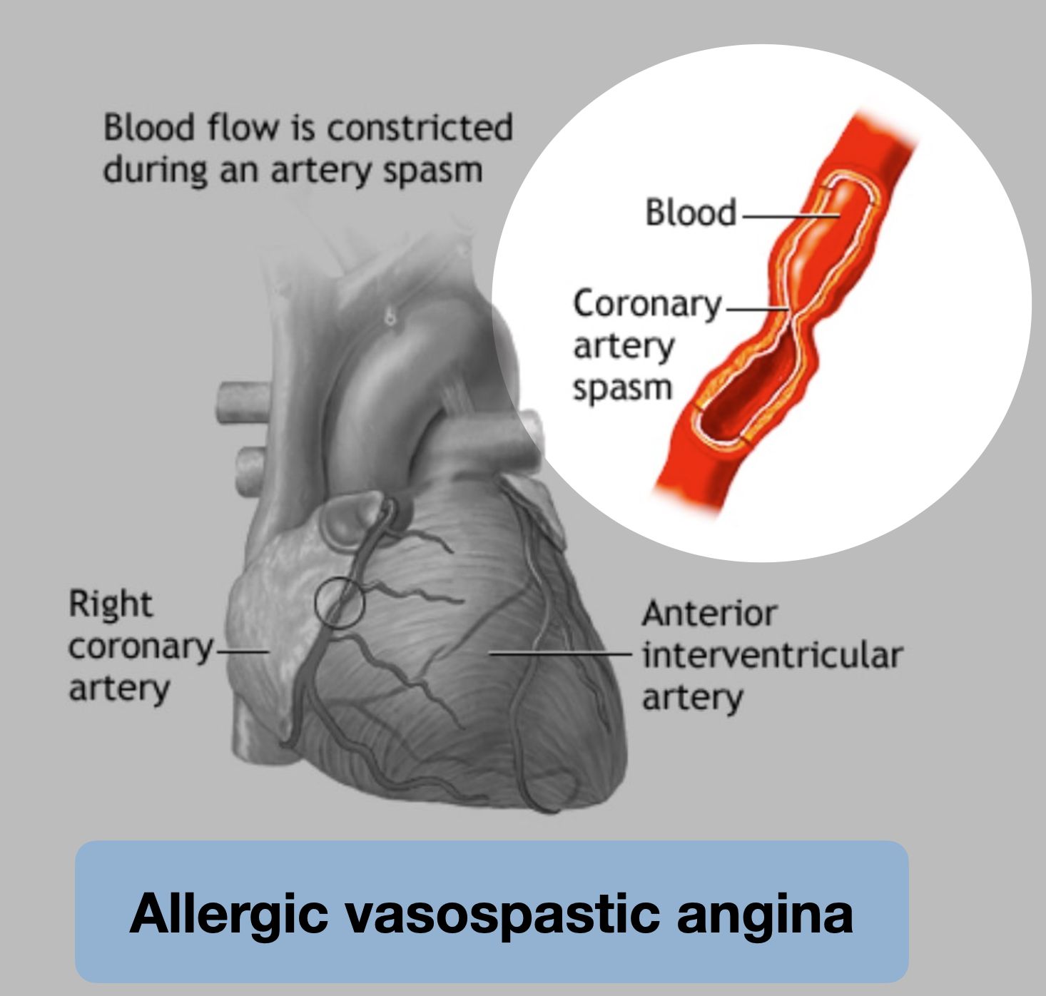 Allergic ACS