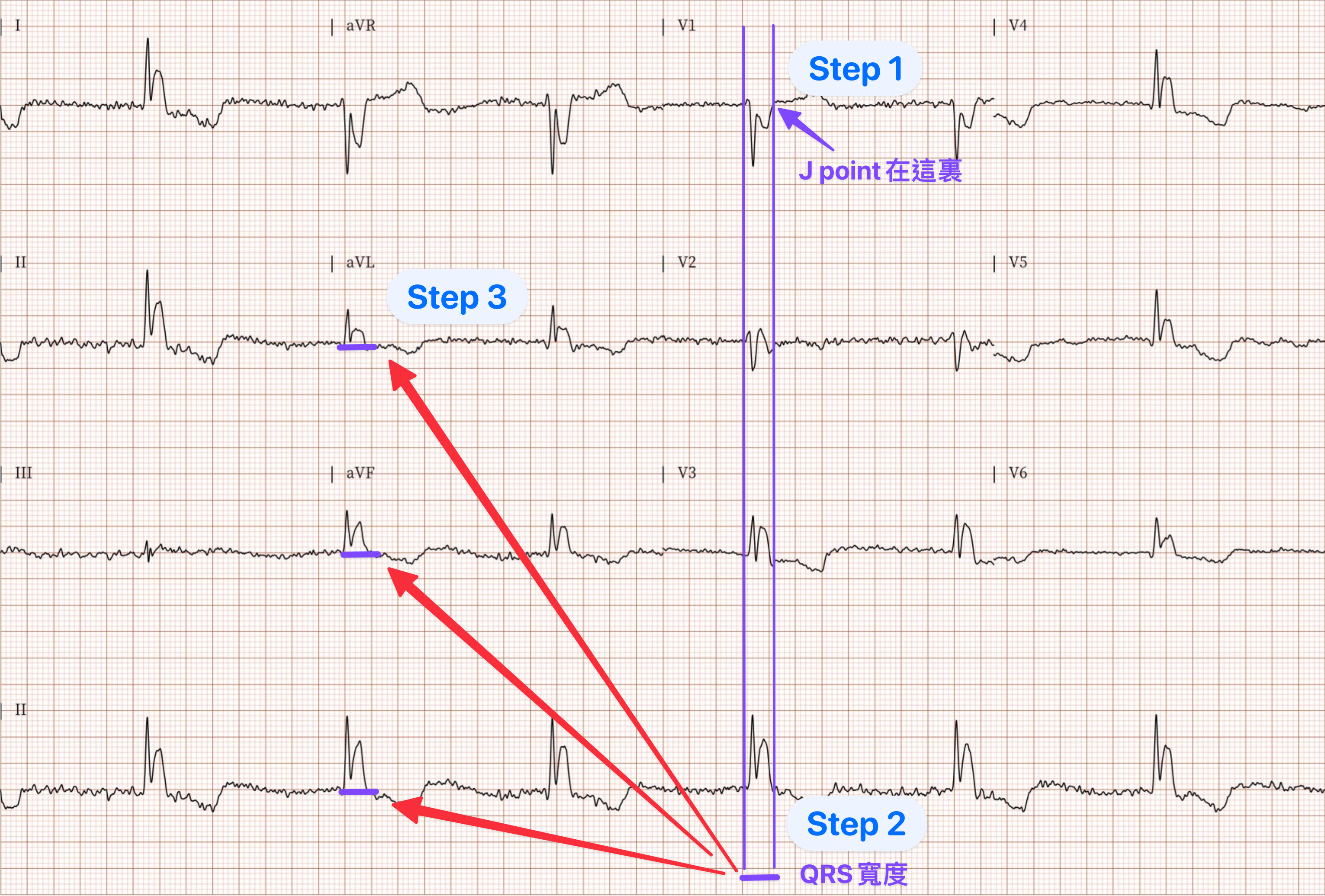 分析prehospital ECG