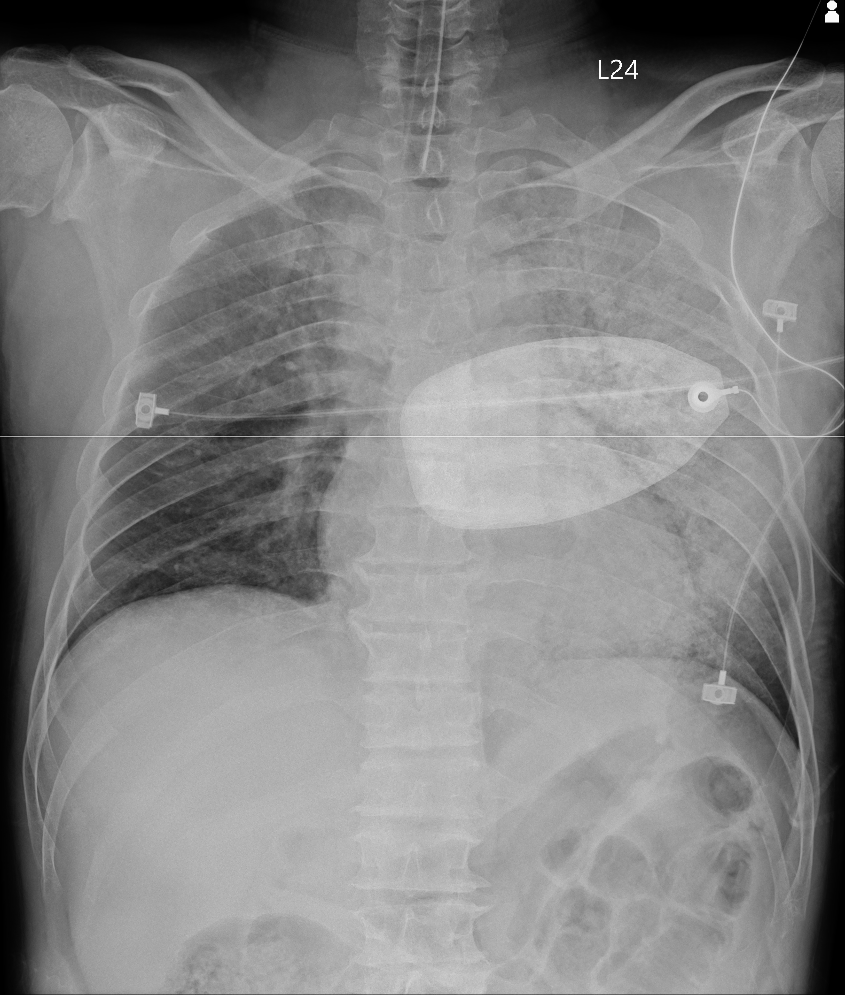 CXR at ER