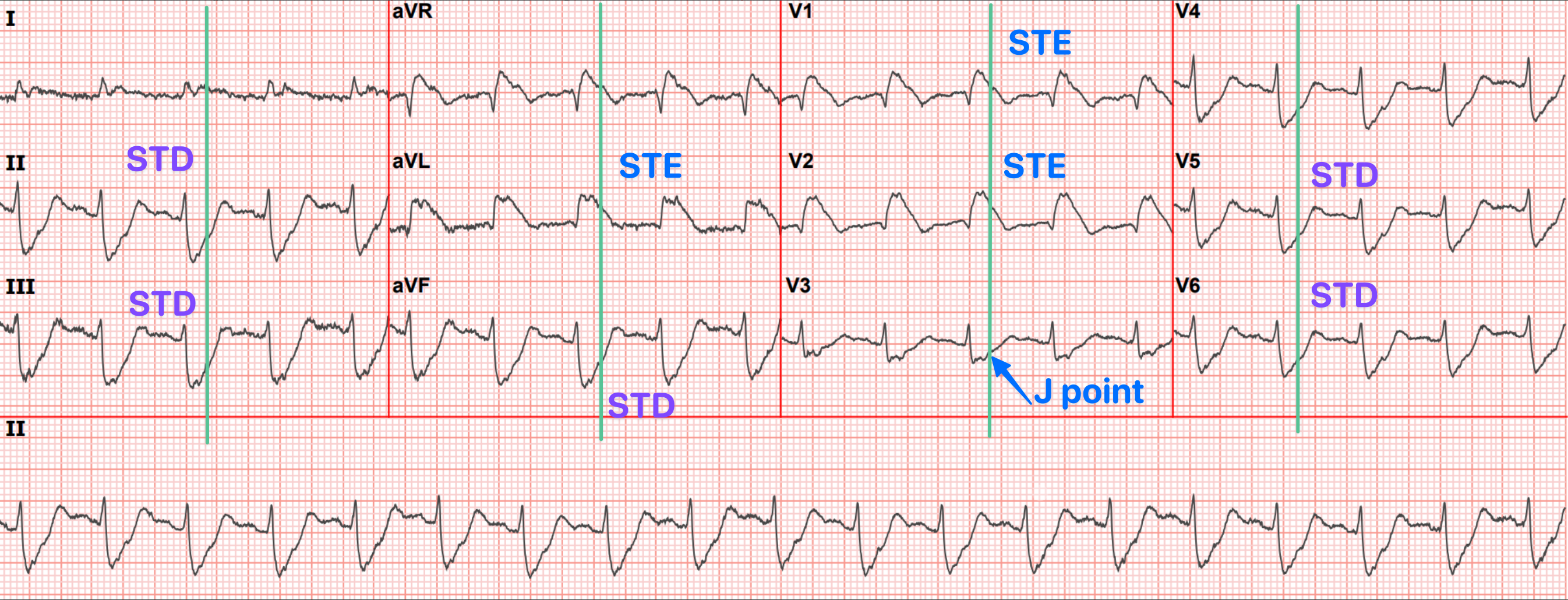 解析ECG