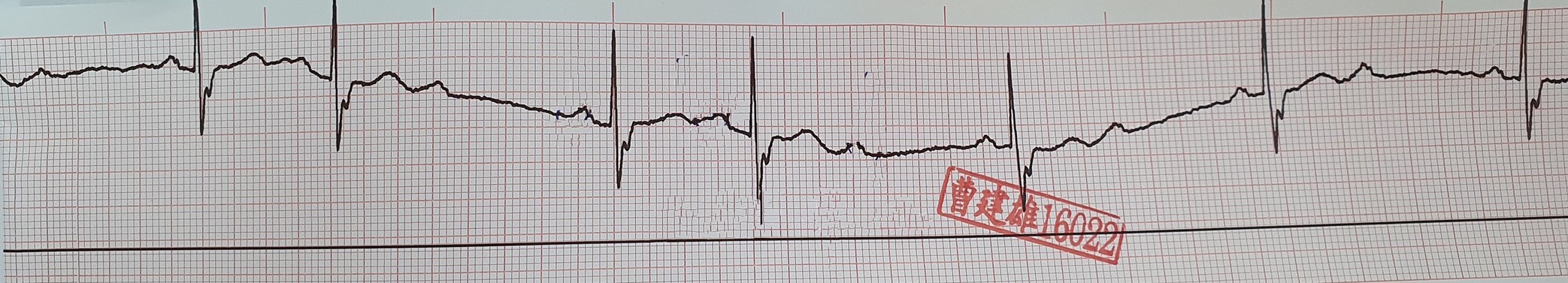 ECG strip when S/S