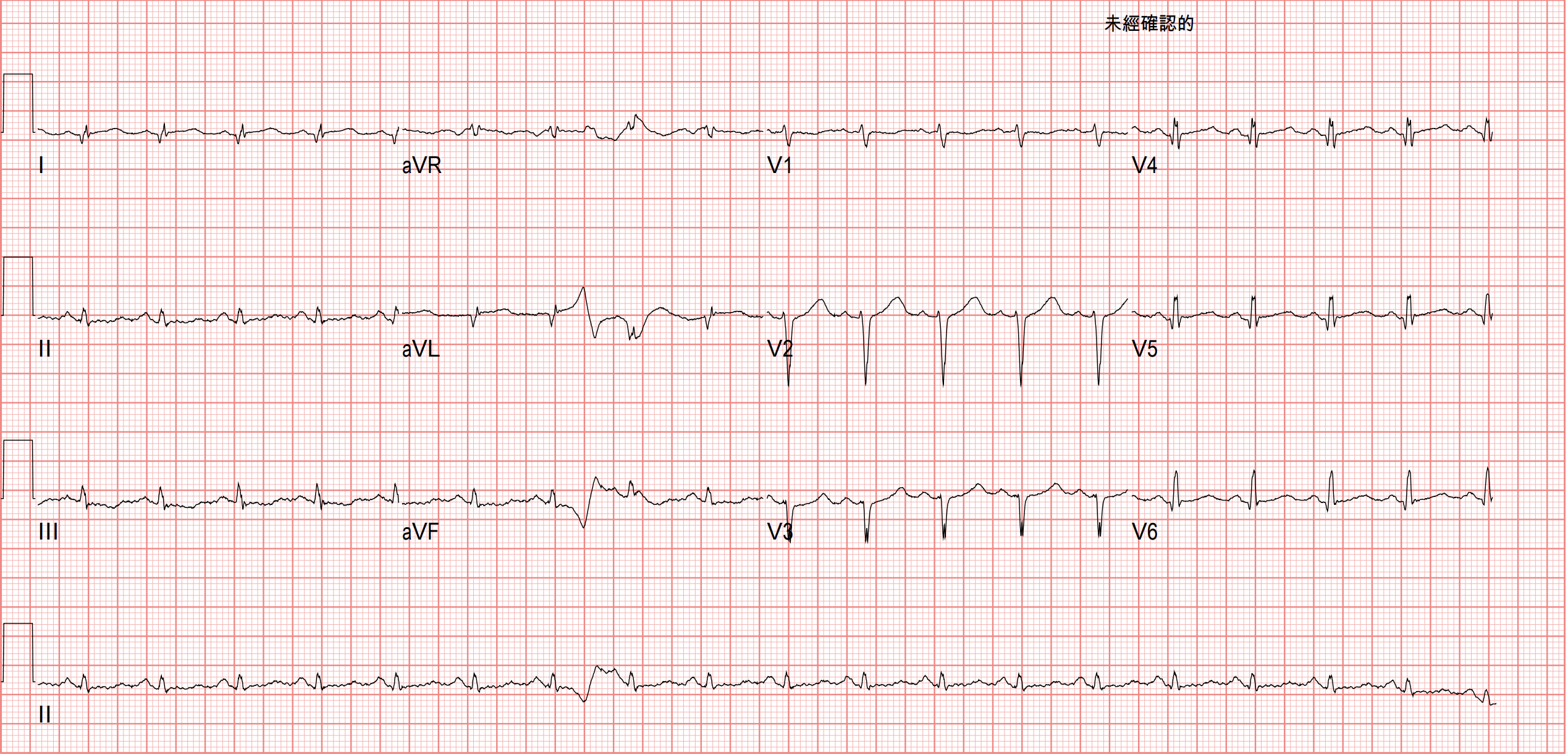 Post PCI ECG