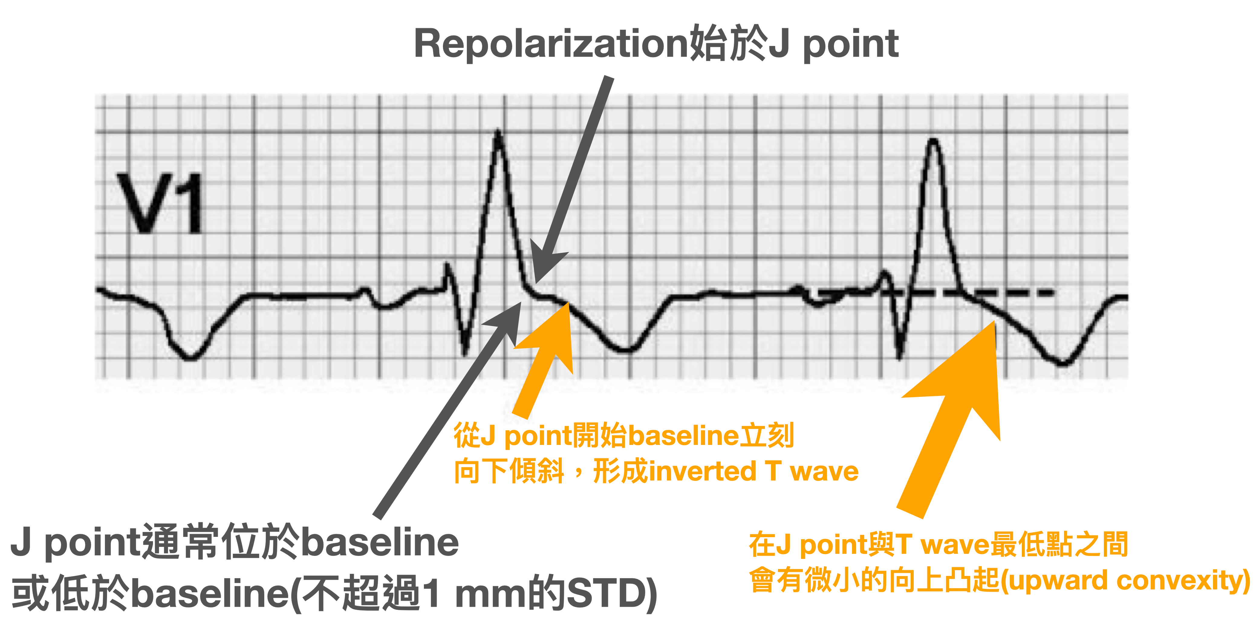 典型RBBB變化 in V1