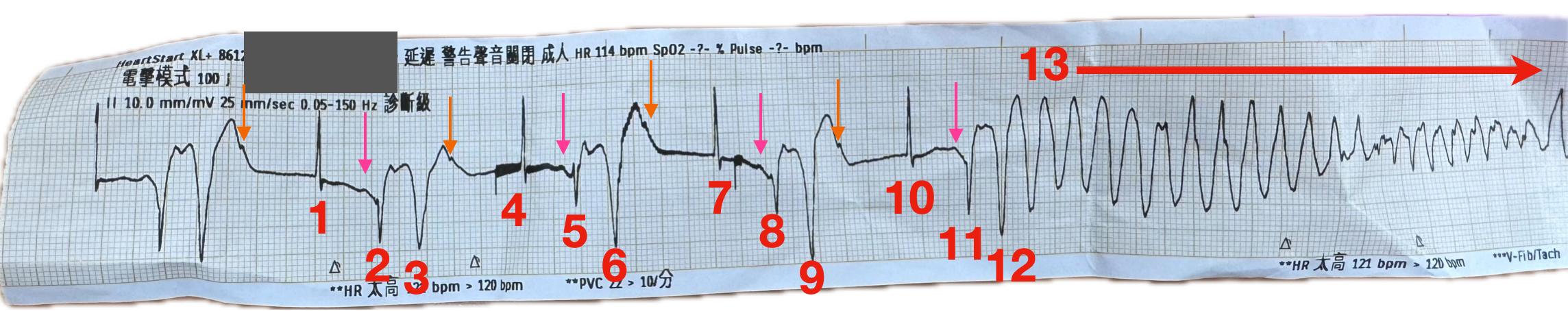 標示過後的ECG strip