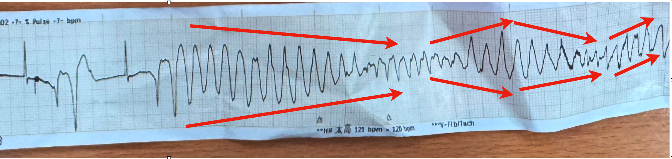 後半段跳心律不整的strip