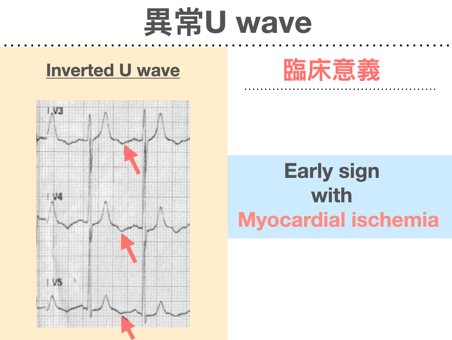 Inverted U wave