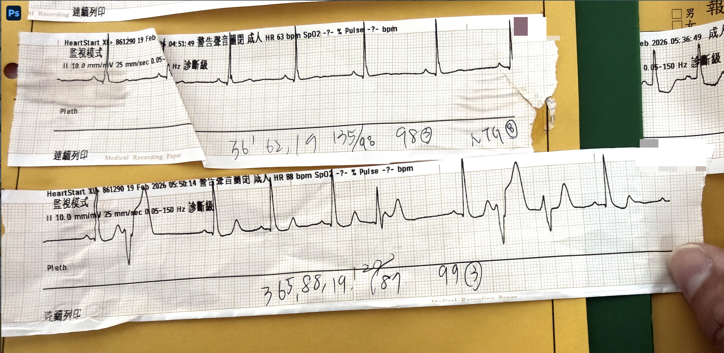 再度大痛的ECG strips