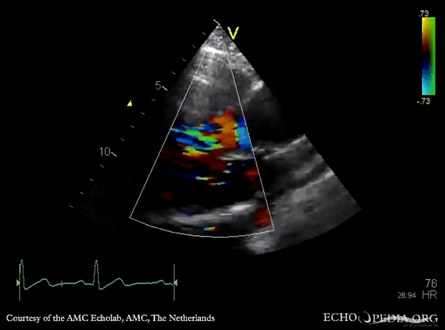AR 的 PLAX + color Doppler