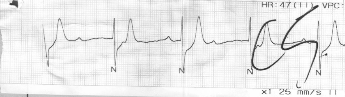 去導管前的 ECG strip