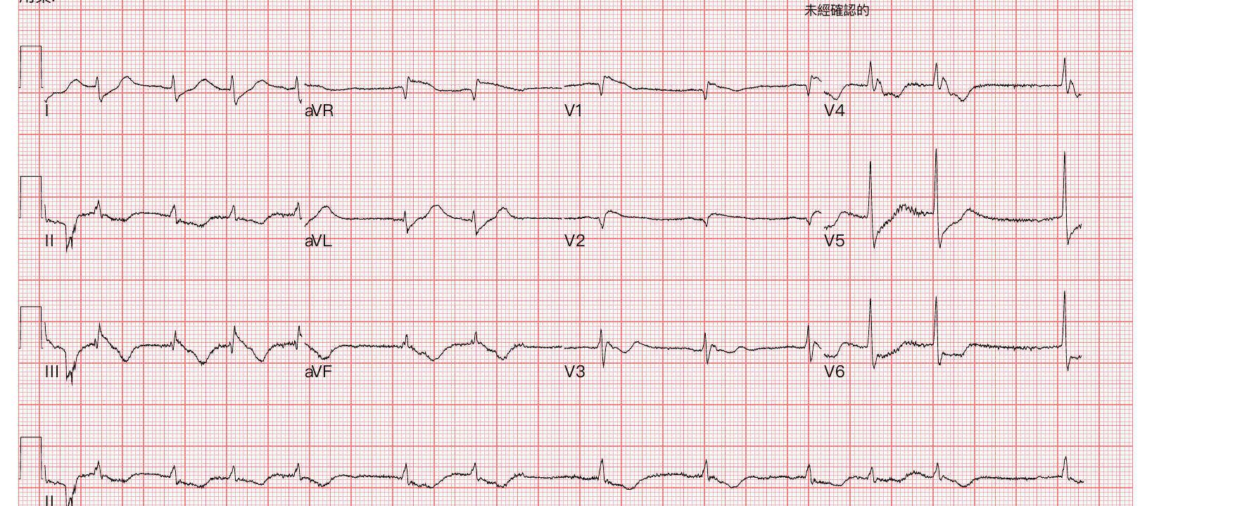 Case 2 到院 ER arrival ECG