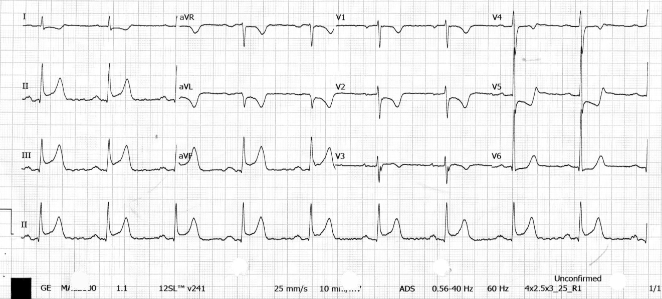 明明在救 ACS，怎麼會是主動脈剝離？——兩個偽裝成 STEMI 的 Type A Aortic Dissection