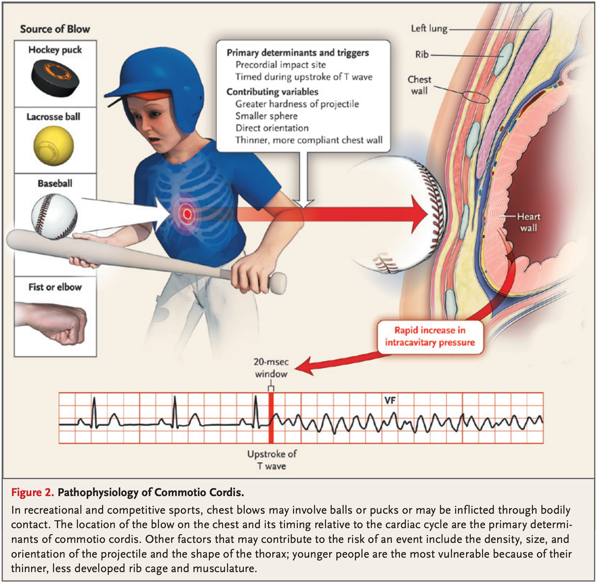 Commotio cordis病生理