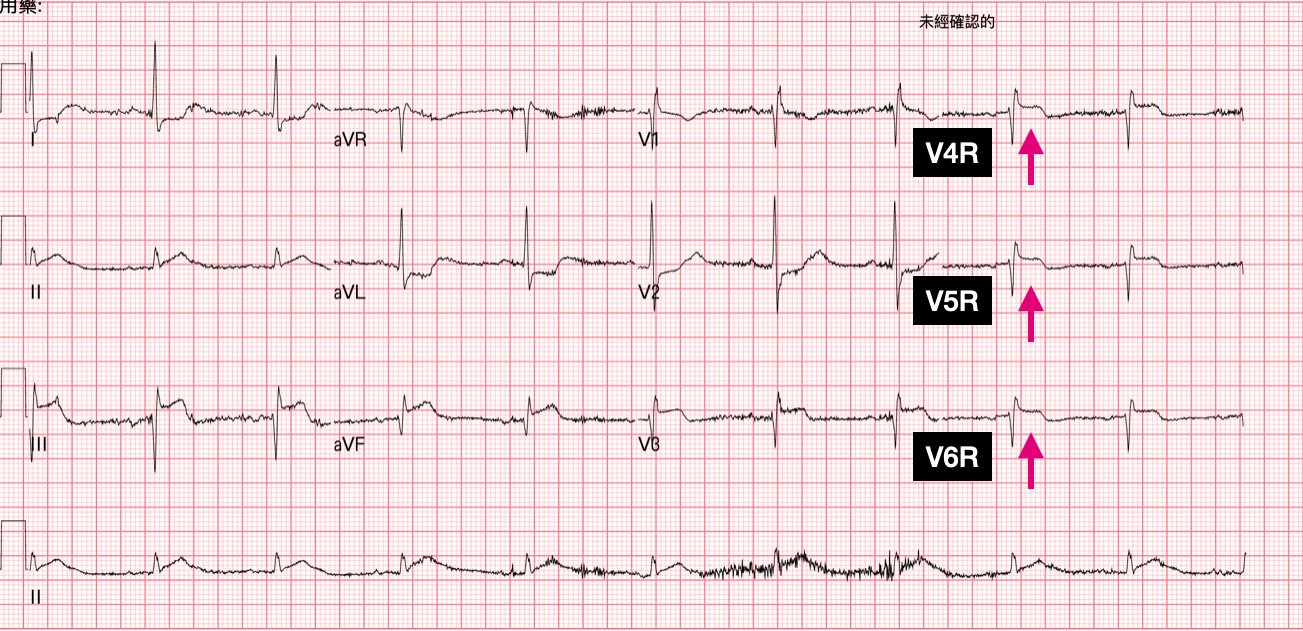 R't side ECG