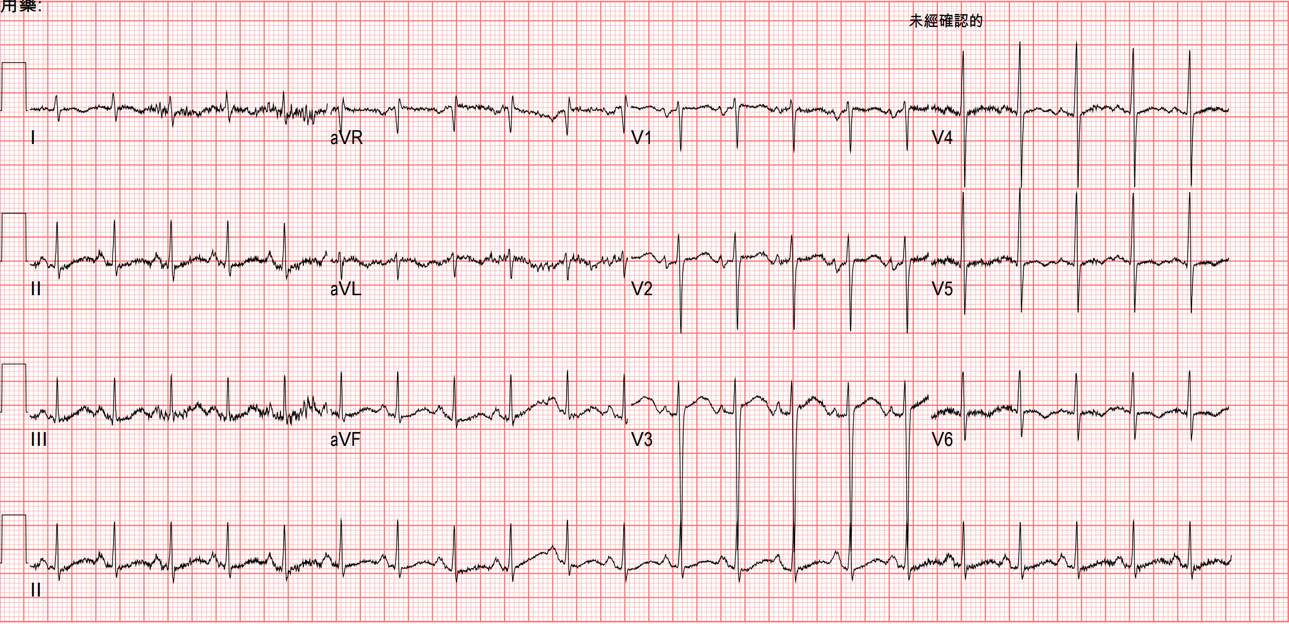 Post DC shock的ECG
