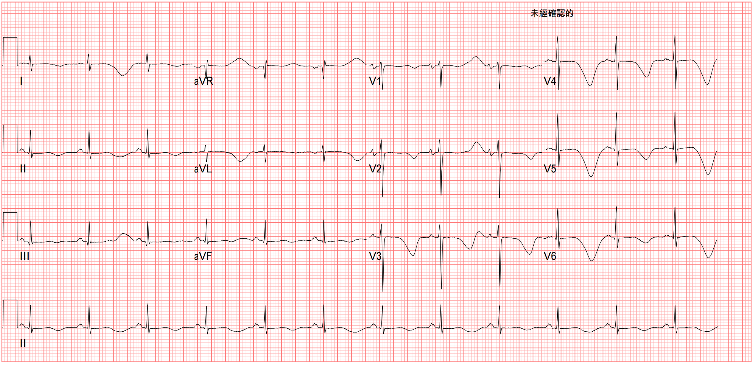 隔天ICU的ECG