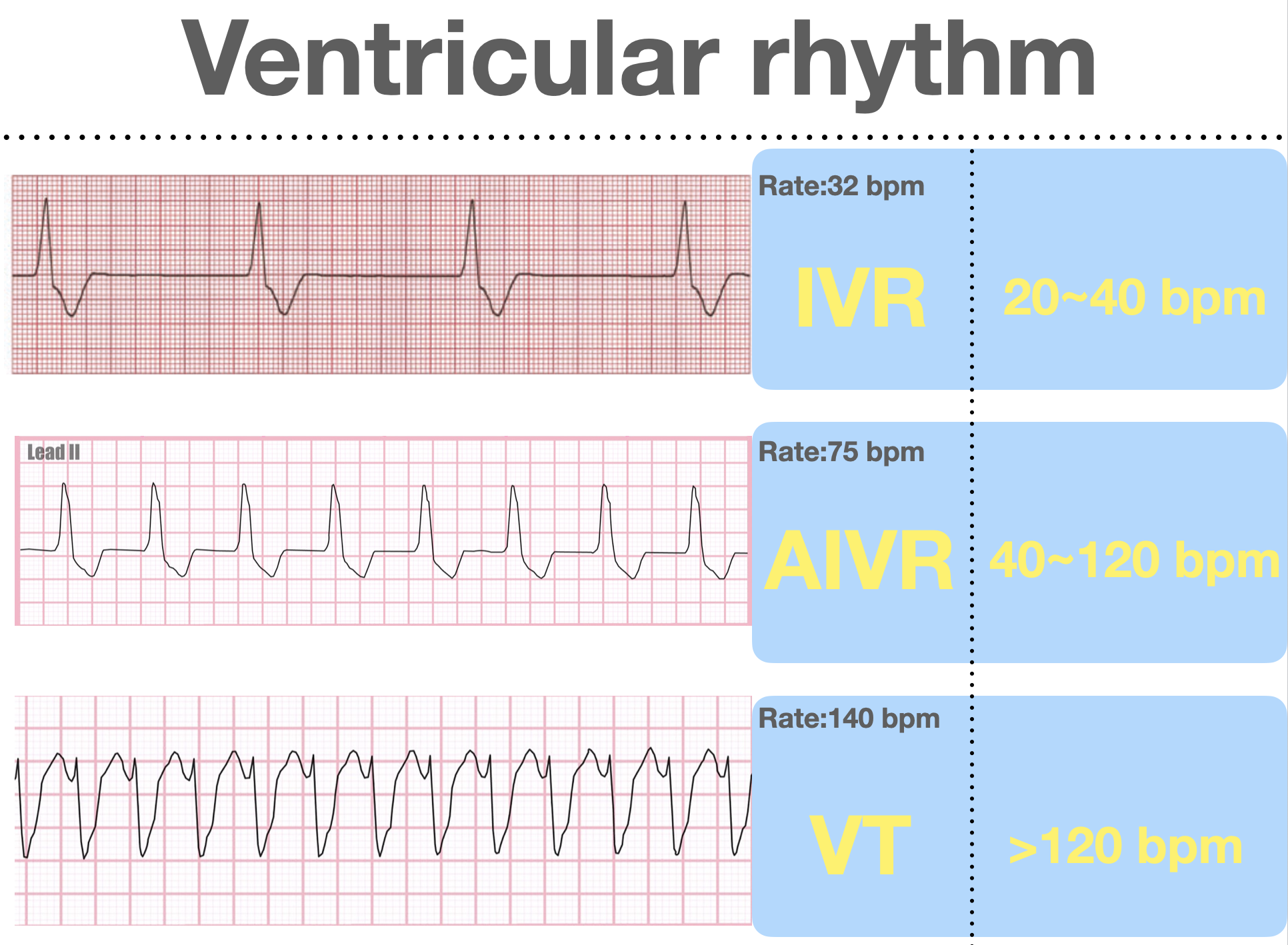 Ventricular rhythm