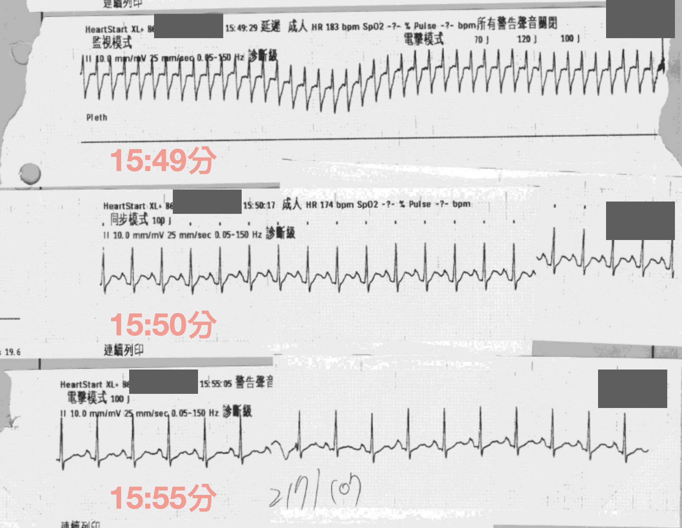 Serial dynamic ECG strips