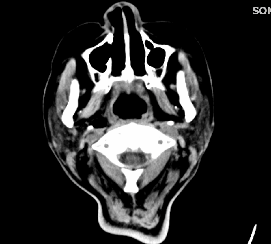Brain CT