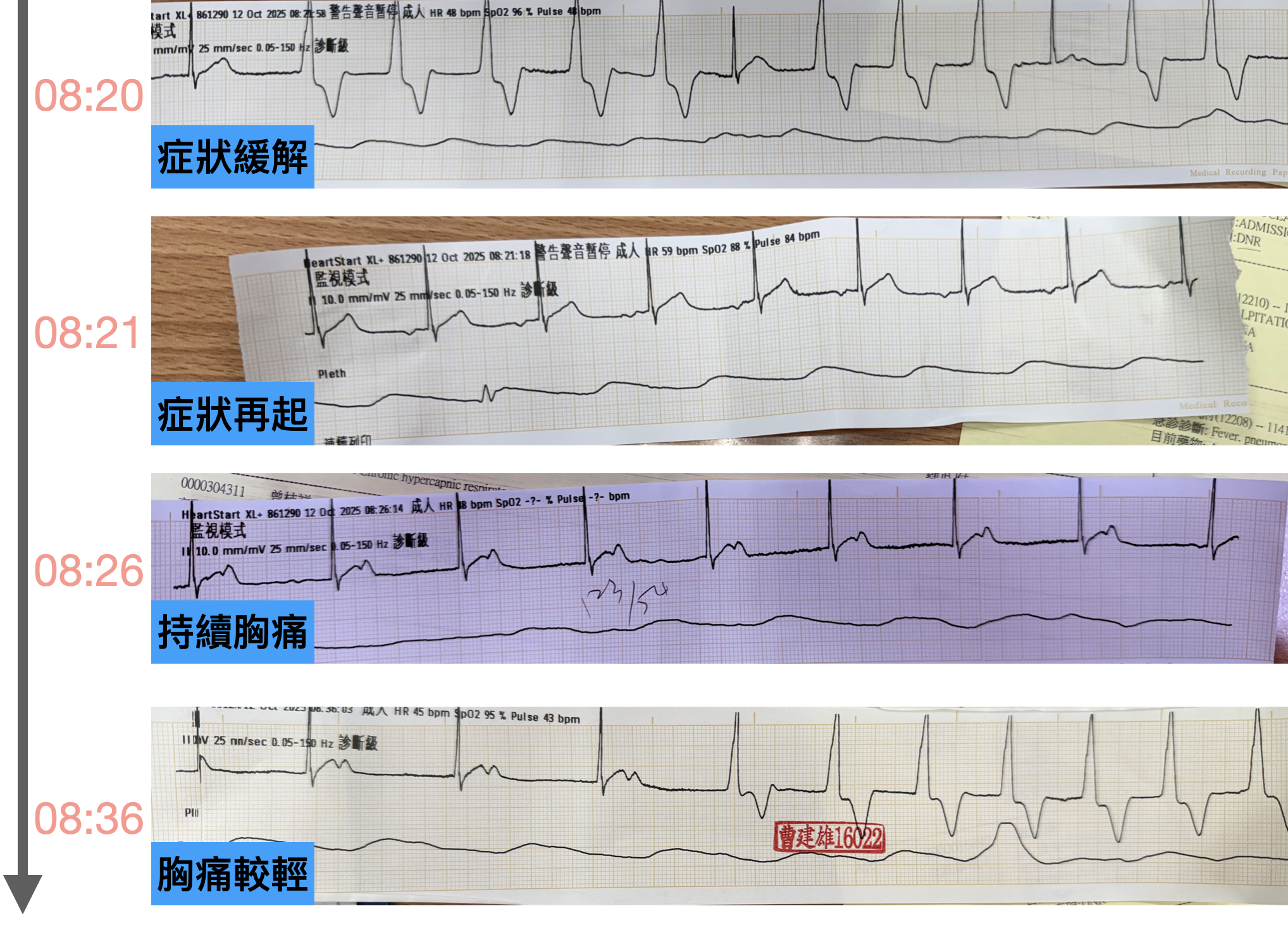 Serial ECG+ACS S/S