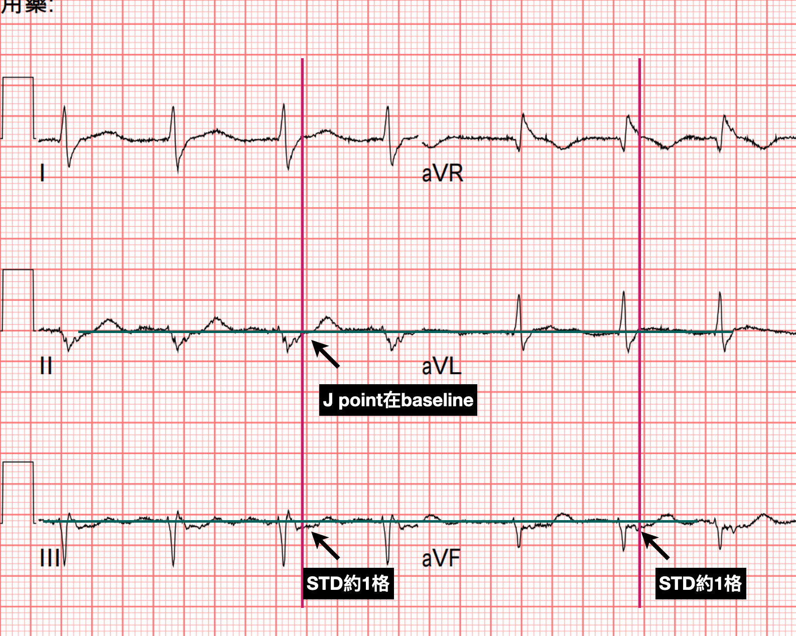 Limb leads ECG