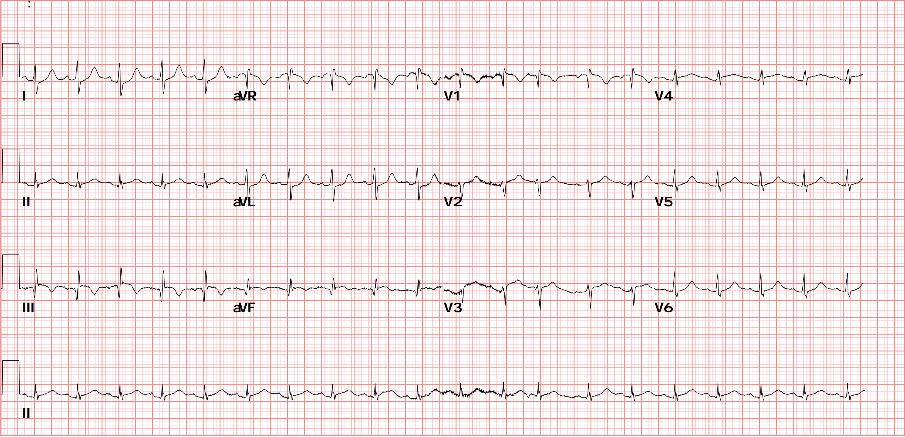 ROSC後的ECG