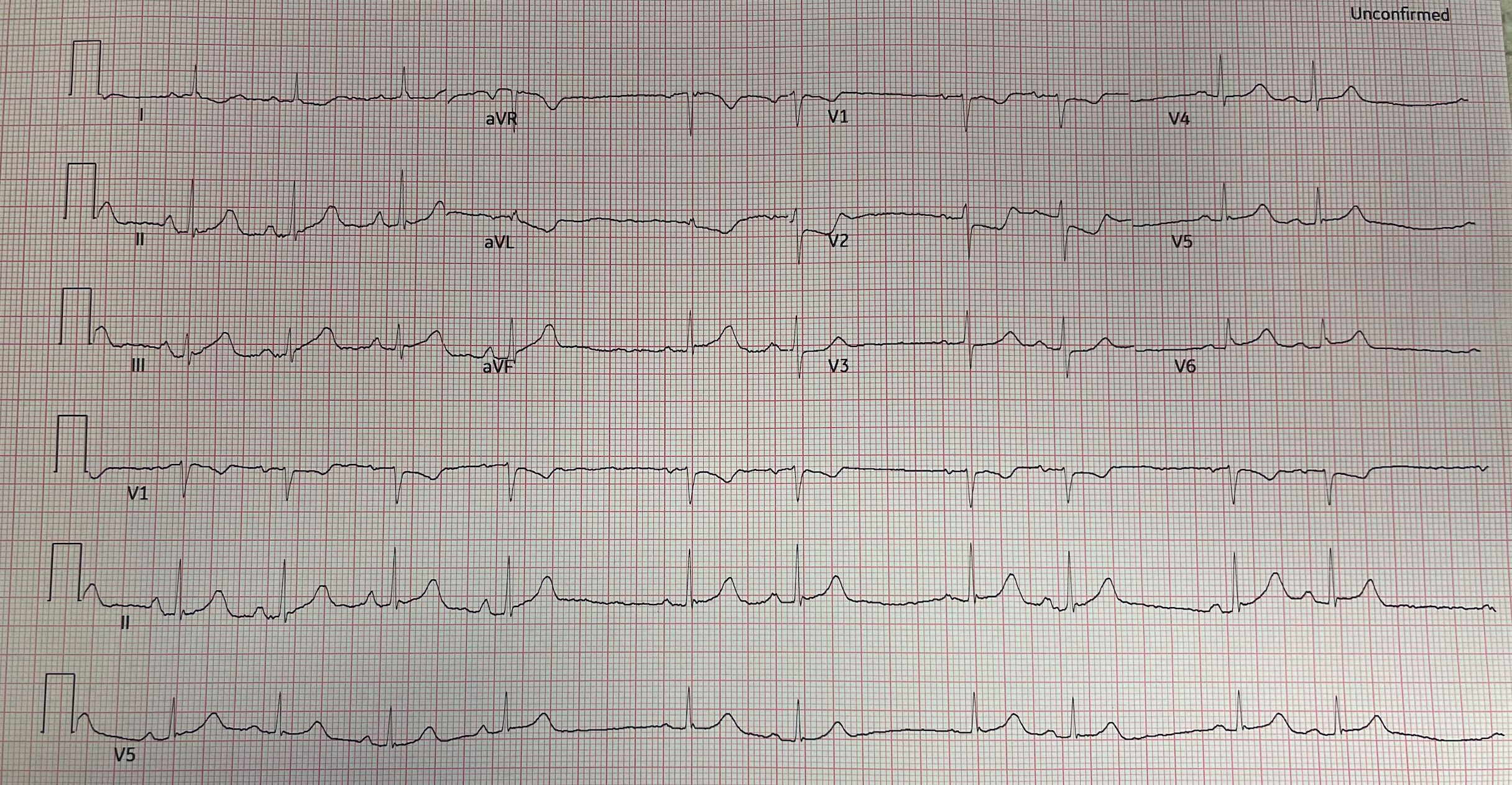 downsloping STD