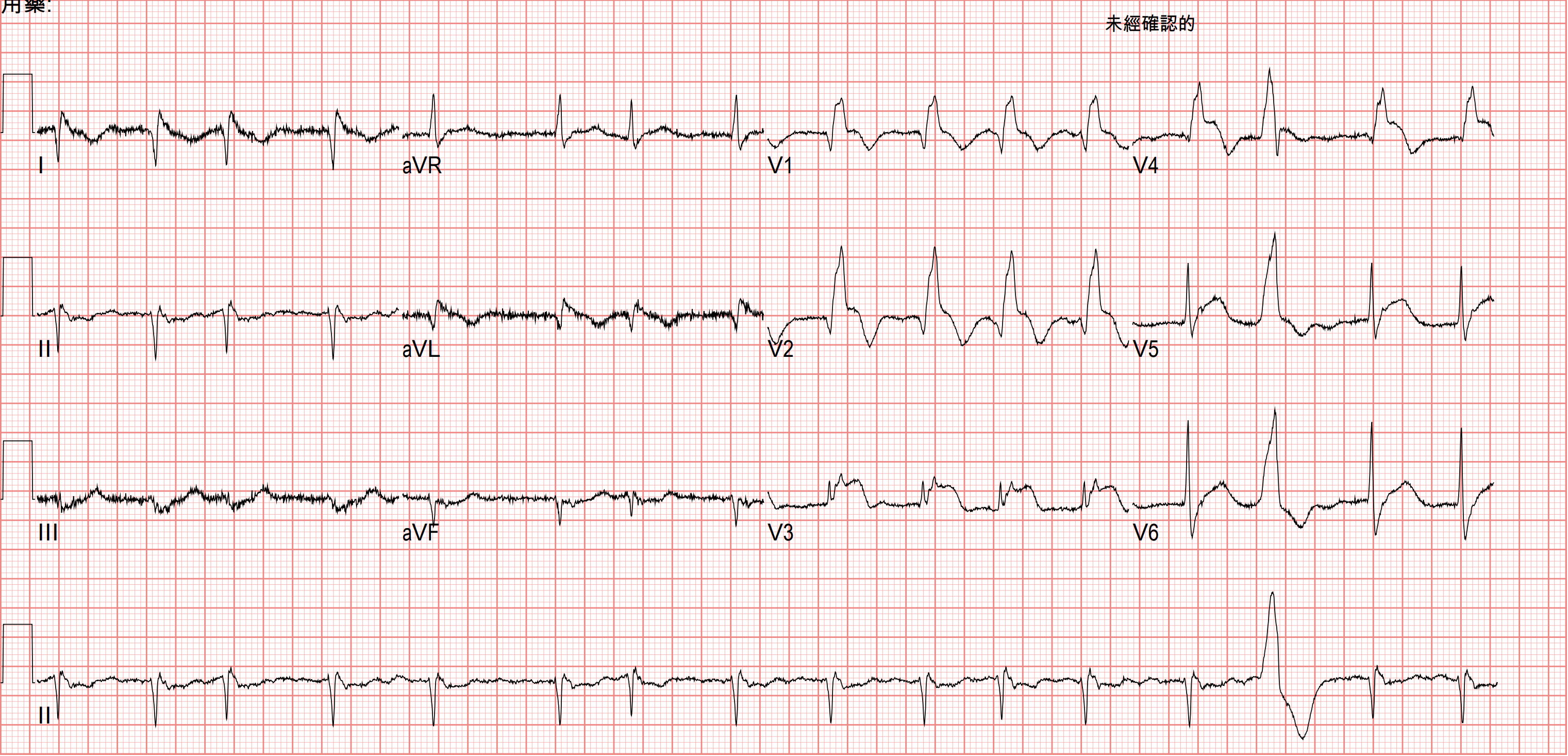 到院4小時後的ECG