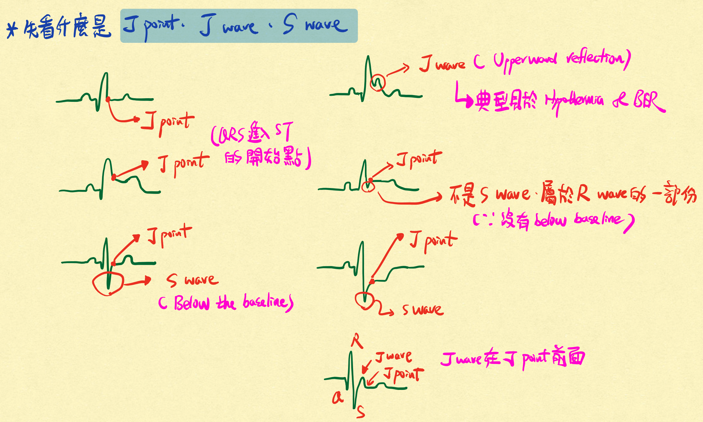 分辨J point和J wave