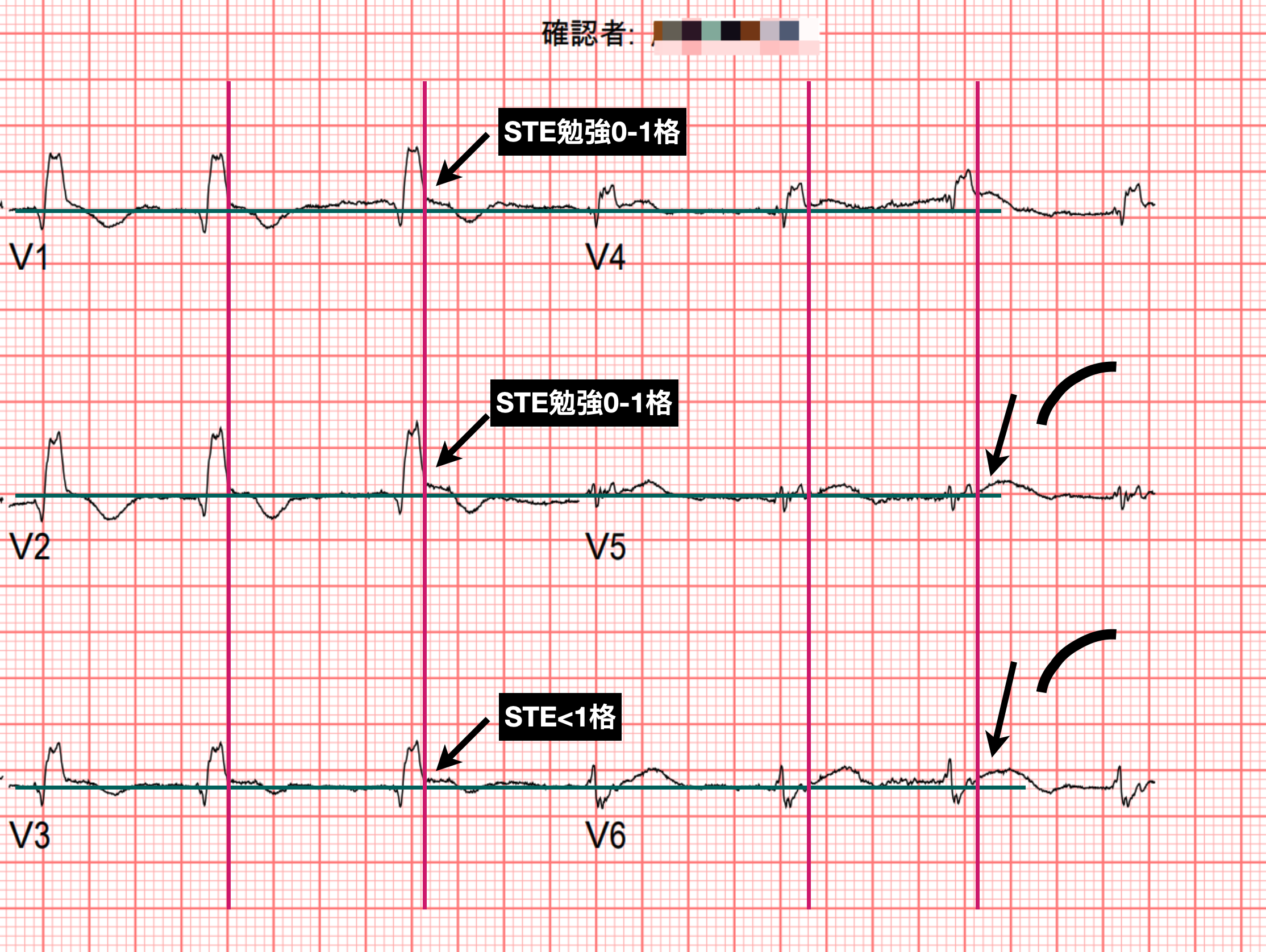 Chest leads