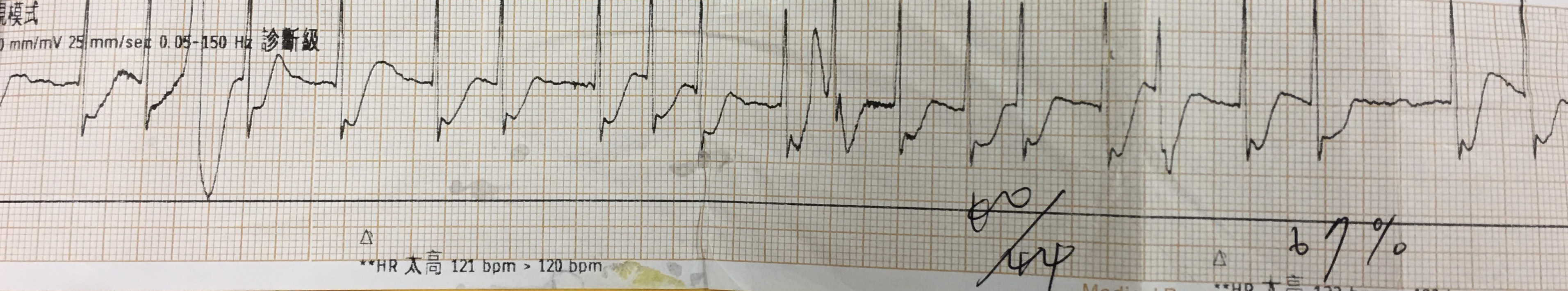 16:39➔急救室ECG strip