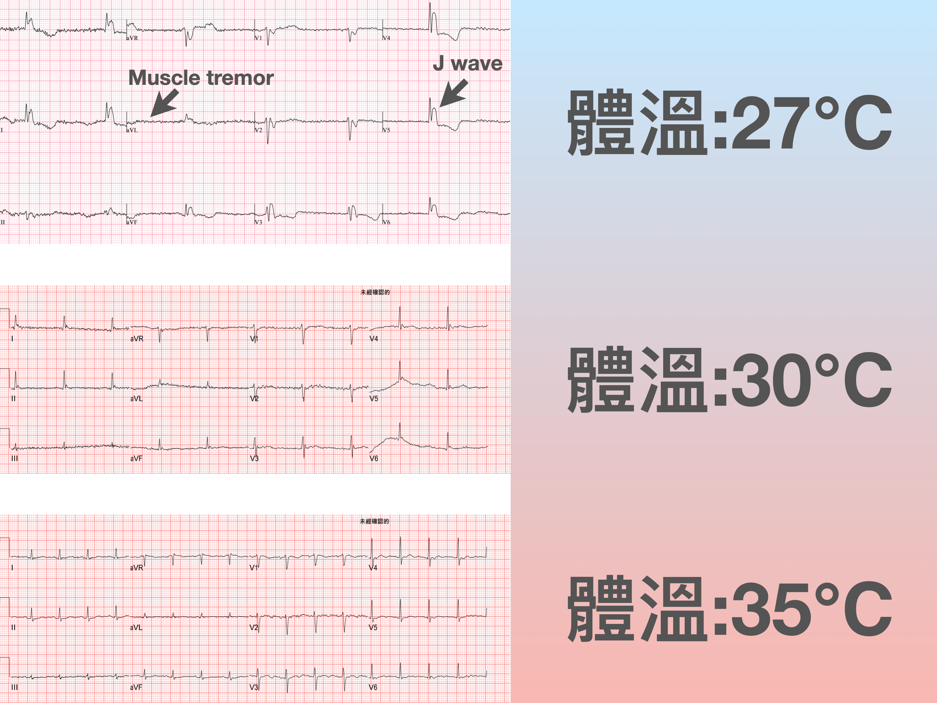 增溫後的Serial ECG