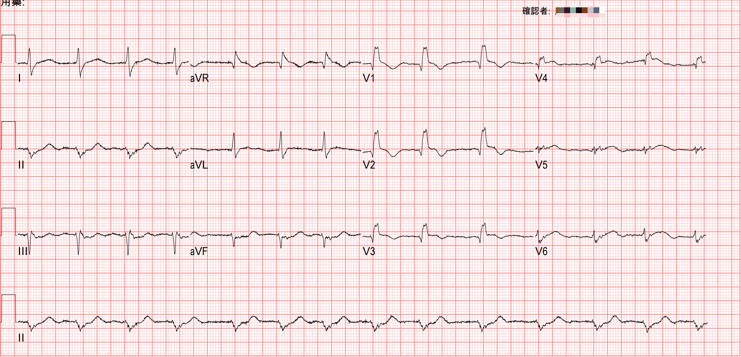 ER arrival ECG