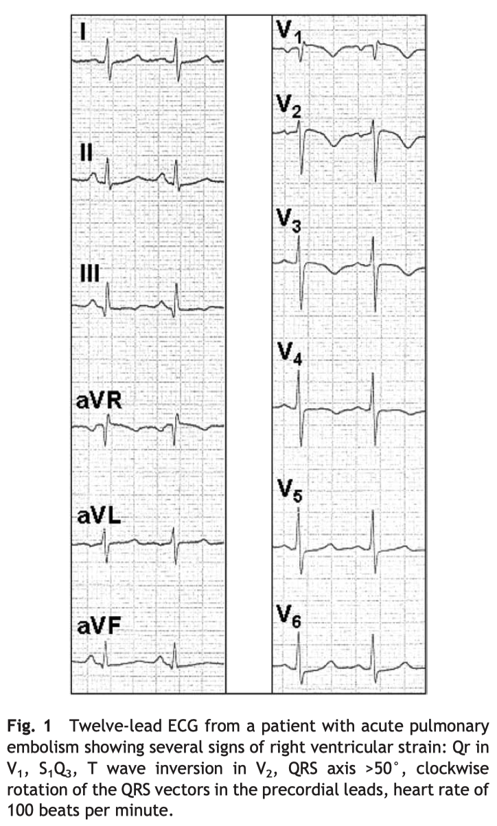 Qr in V1 ECG case