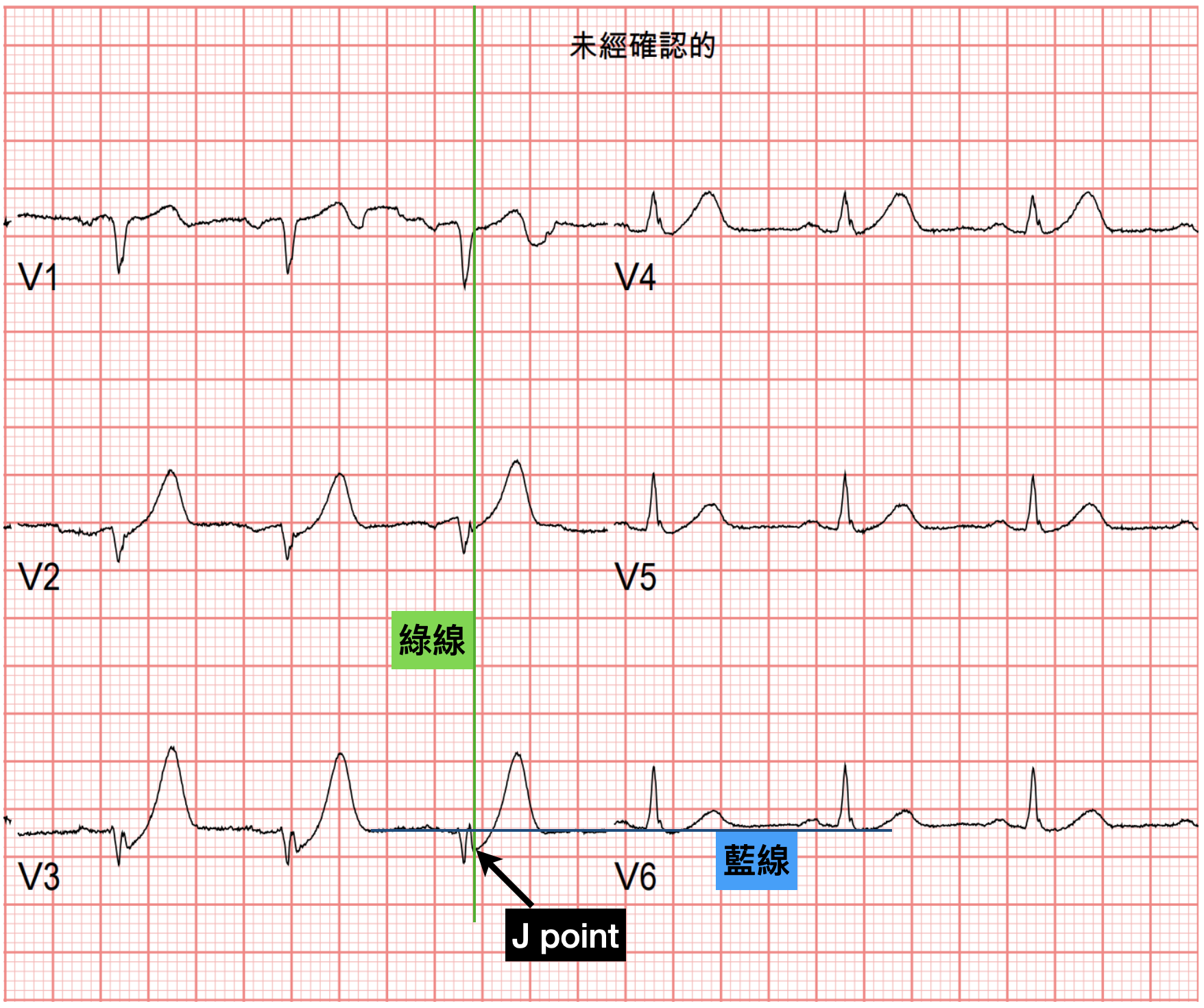 病患Precordial leads ECG change